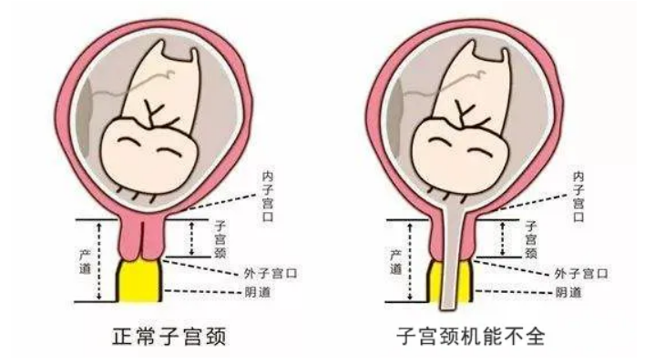 关于先兆流产,北京家恩德仁医院表示:可能与宫颈机能不全有关