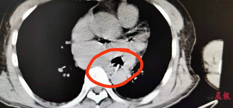 ct影像学检查报告显示:一块2厘米长的异物牢牢刺入食道中,甚至还刺