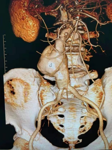 80岁老人腹主动脉瘤随时破裂亚心专家化身拆弹专家