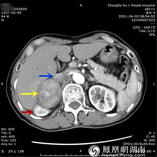 ct检查发现右肝巨大肿瘤,诊断考虑肝癌,患者肿瘤巨大(直径达24cm,切下