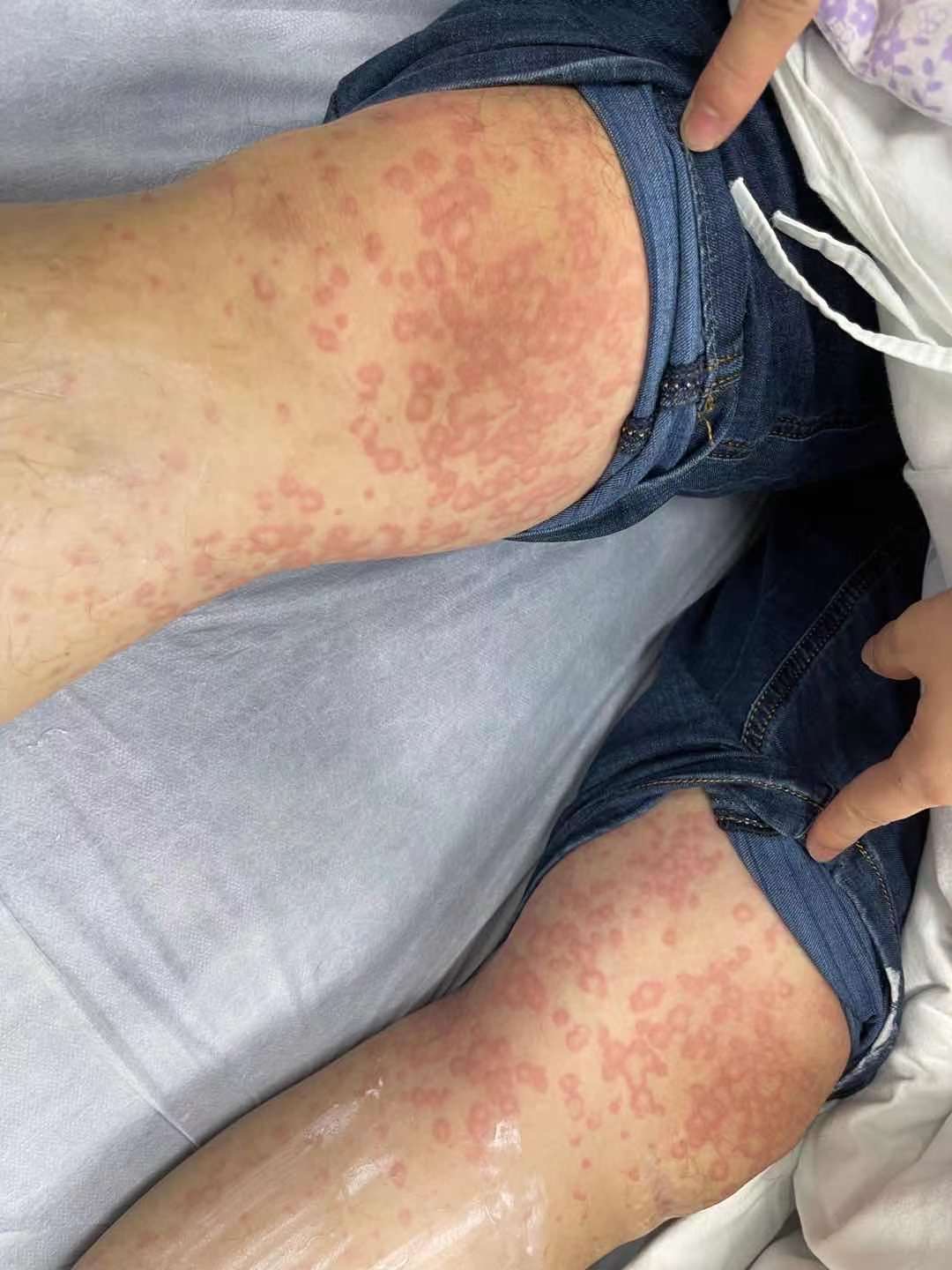 长沙42岁男子自服一片止痛药身上起满红疹躺进icu