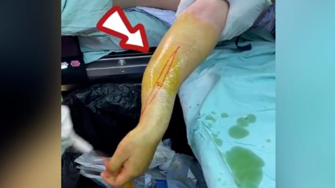 上海16岁男生和同学掰手腕粉碎性骨折