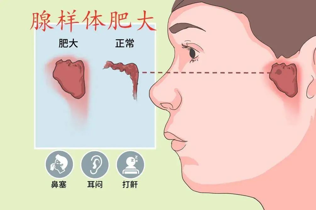 成都民生耳鼻喉医院提示:腺样体面容几乎不可逆 腺样体肥大在作怪!