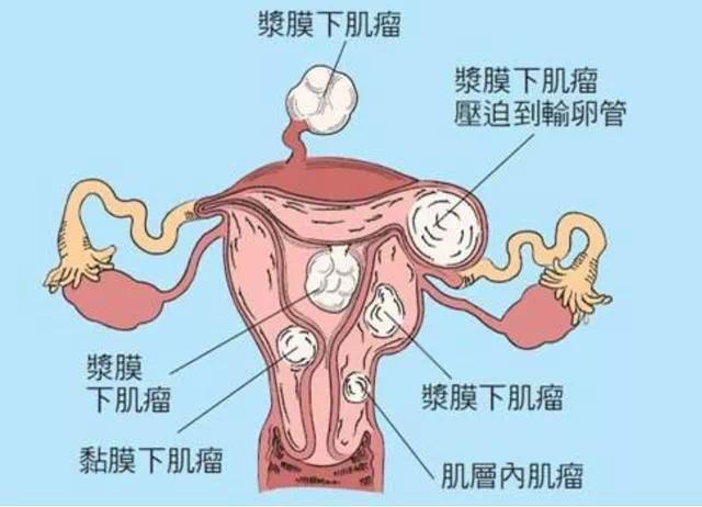 西安市大兴医院成功切除6斤重的子宫肌瘤