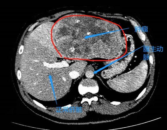 肝脏增强ct所示肝肿瘤