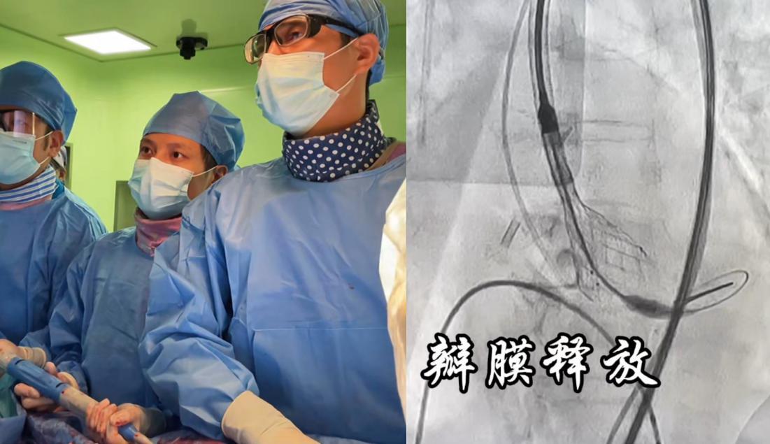 东三省首例哈医大二院成功完成一站式经导管主动脉瓣膜置换术二尖瓣