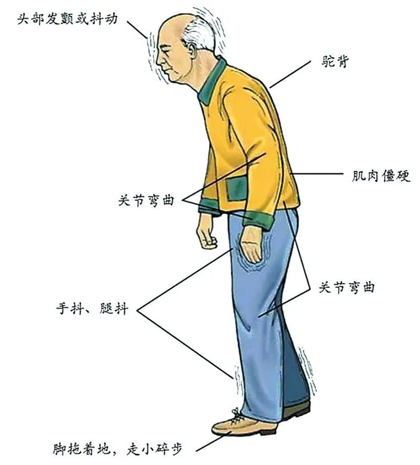 李俊驹主任表示,帕金森病的早期会有颤抖,走路不稳,上肢无力等症状