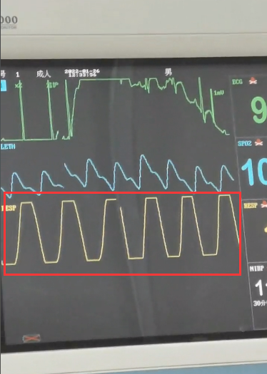 男子住院把心电监测仪玩明白了在心电图上画长城