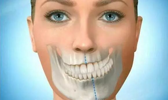 牙齿矫正四种人正畸后脸型变化最大
