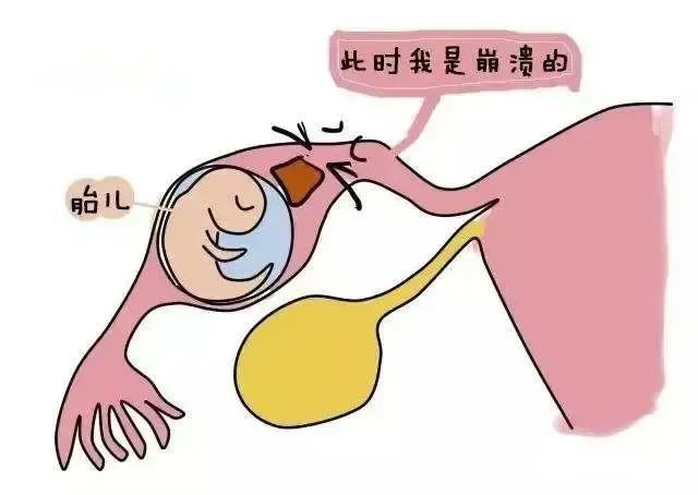 潍坊市人民医院孕早期阴道流血一定发生自然流产吗