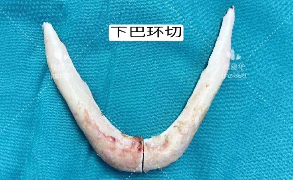 下颌角长曲线和超长曲线和下巴环切的区别籍建华下颌角