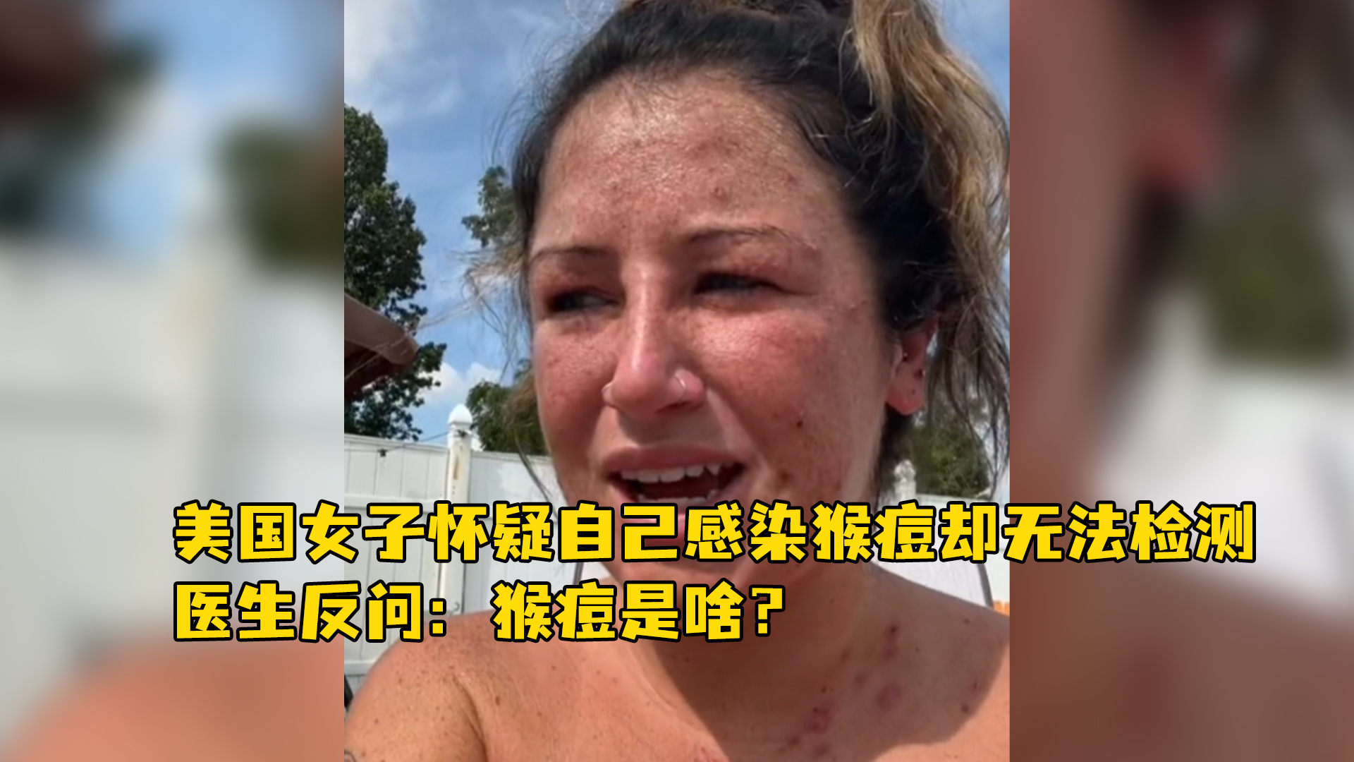 美国女子怀疑自己感染猴痘却无法检测医生反问猴痘是啥