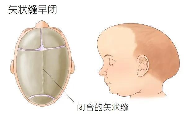 陕西>健康>新闻热点>正文>因为头顶部的骨缝(矢状缝)过早闭合了,才