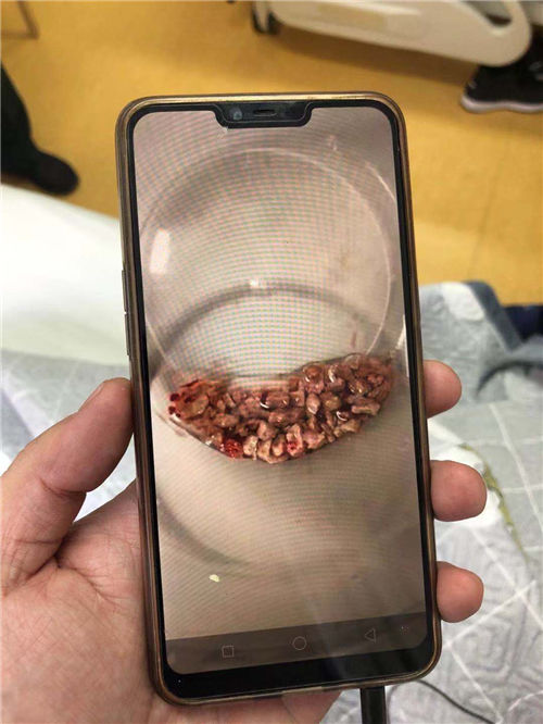 双肾充满结石排尿难 远东名医为患者巧取肾结石