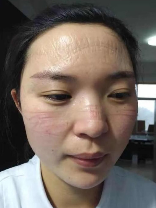 罗山县人民医院毕小慧脸上的勒痕是你最美的勋章