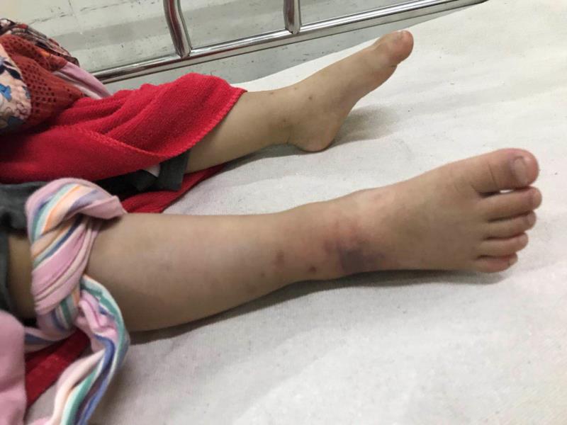 江门一男童遭蝰蛇咬伤 新会交警搭建生命绿色通道