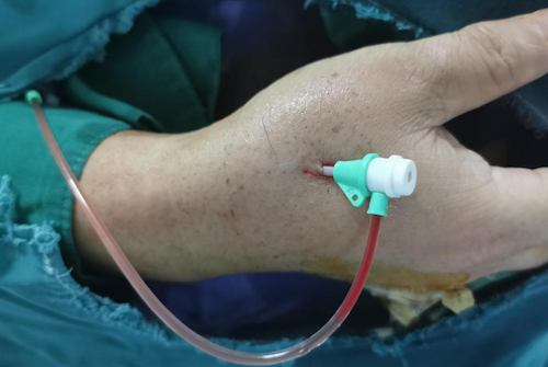 图2 远端桡动脉穿刺部位