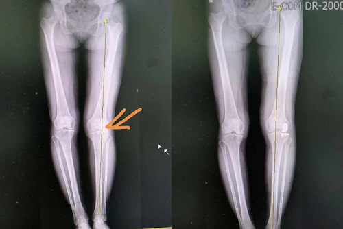 你的膝关节需要补补牙吗青岛市市立医院成功开展膝关节外侧单髁置换术