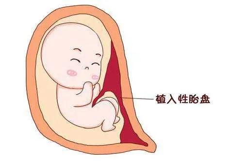 潍坊市人民医院一例凶险性前置胎盘合并胎盘植入产妇顺利分娩