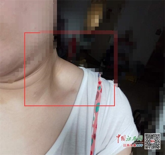 女子双下巴抽脂颈部却凹陷 南昌时光医疗整形医生被指无资格证