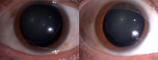 惊险双眼晶体大范围脱位疑难白内障手术被攻克