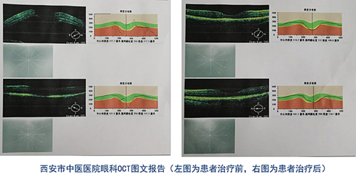 眼科oct检查报告怎么看图片