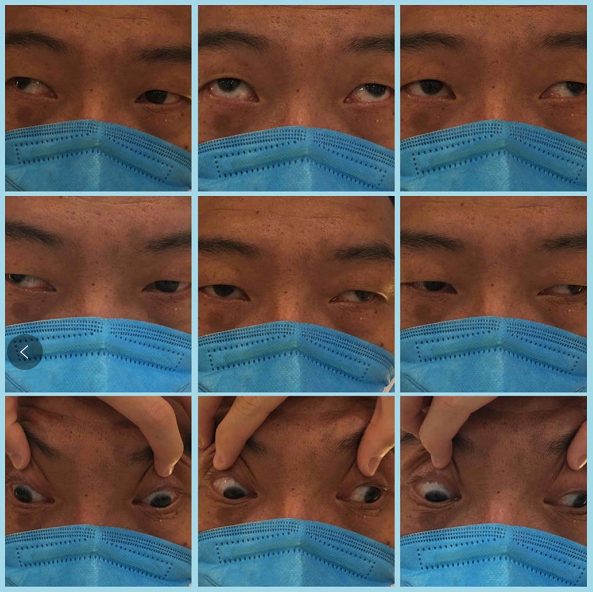 疑难斜视遇上眼球震颤30岁男子在普瑞眼科解决顽疾重拾自信