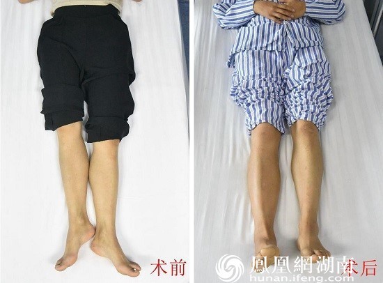 格桑卓玛术前术后下肢长度对比（说明：患者多年右下肢短缩，导致骨盆倾斜，术后照片显示右下肢稍长，随着患者自行行走时间延长，骨盆倾斜纠正，双下肢会达到基本等长。）