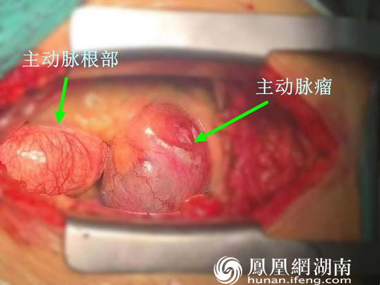 术中暴露主动脉根部动脉瘤