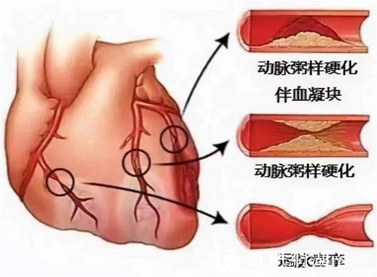 各种原因导致的血管痉挛、动脉粥样硬化、血栓形成均可引发心肌缺血梗死。