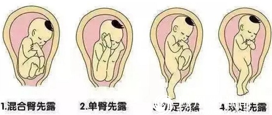 &nbsp; 正常的胎位是头位，即胎儿在母体中处于倒立的状态，头部朝下、臀部朝上，分娩时头部先行娩出。臀位是指胎儿头部朝上，臀部朝下，分娩时臀先露。足先露是指胎儿呈单足或者双足立于骨盆中,以足部为先露部位，足先露意味着脐带很可能将随着羊水的流出，顺着胎儿的小脚脱落至产道。