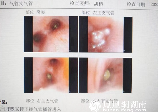 纤维支气管镜检查发现患儿左、右支气管均有异物