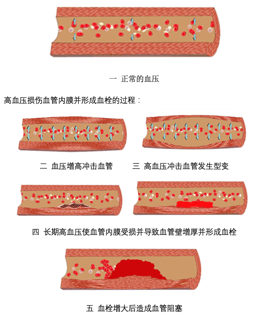 通俗易懂 一文读懂高血压的致病机理