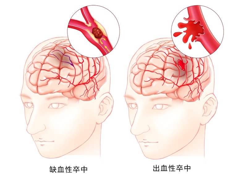 脑溢血，占比10 25%。但无论哪种，他们最重要的发病关联因素就是高血压。