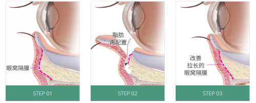 韩国眼袋脂肪排列韩国佰诺佰琪医院眼底脂肪再配置如何有效改善 