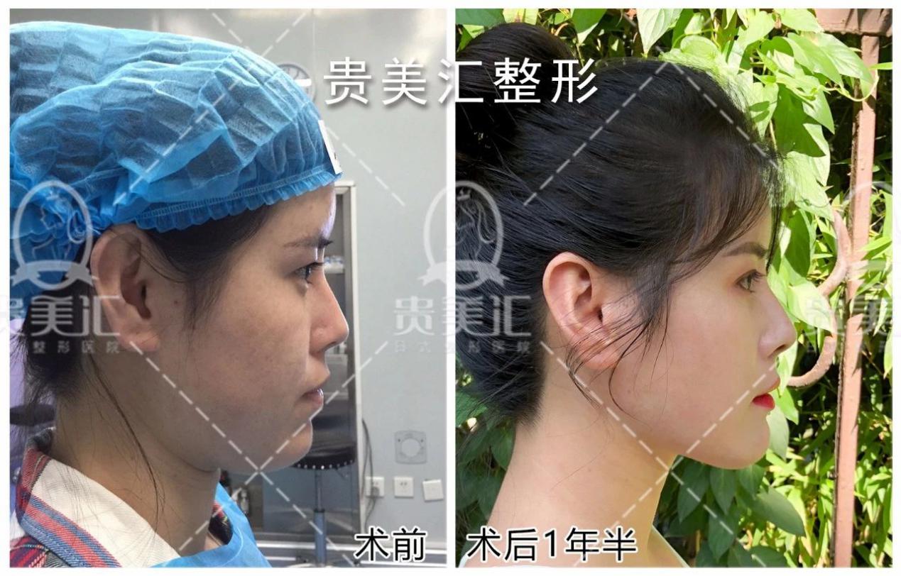 面部提升除皱效果好吗？北京加减美面部年轻化专科 - 哔哩哔哩