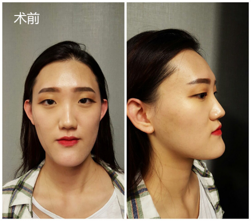 韩国长脸矫正哪家医院做的好?看必妩双鄂和轮廓手术案例自己判断吧