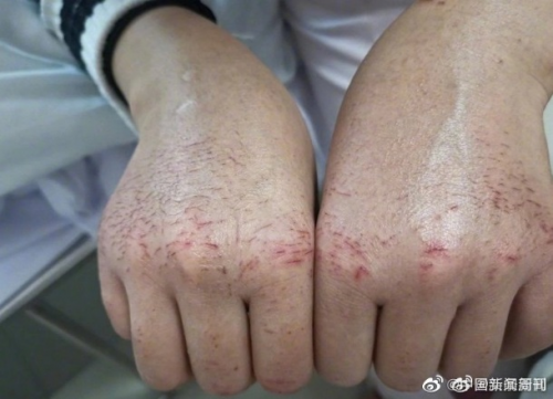 医护人员的手还因为终日被消毒液,洗手液,滑石粉浸泡浸蚀着而严重过敏