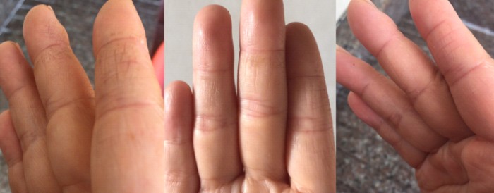 手指裂口怎么办 手裂口修护经验分享 河北频道 凤凰网