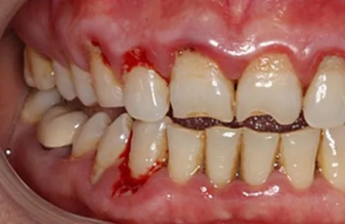 在牙周病中最常见,主要表现有牙龈红肿出血,牙周袋形成,牙周袋溢脓