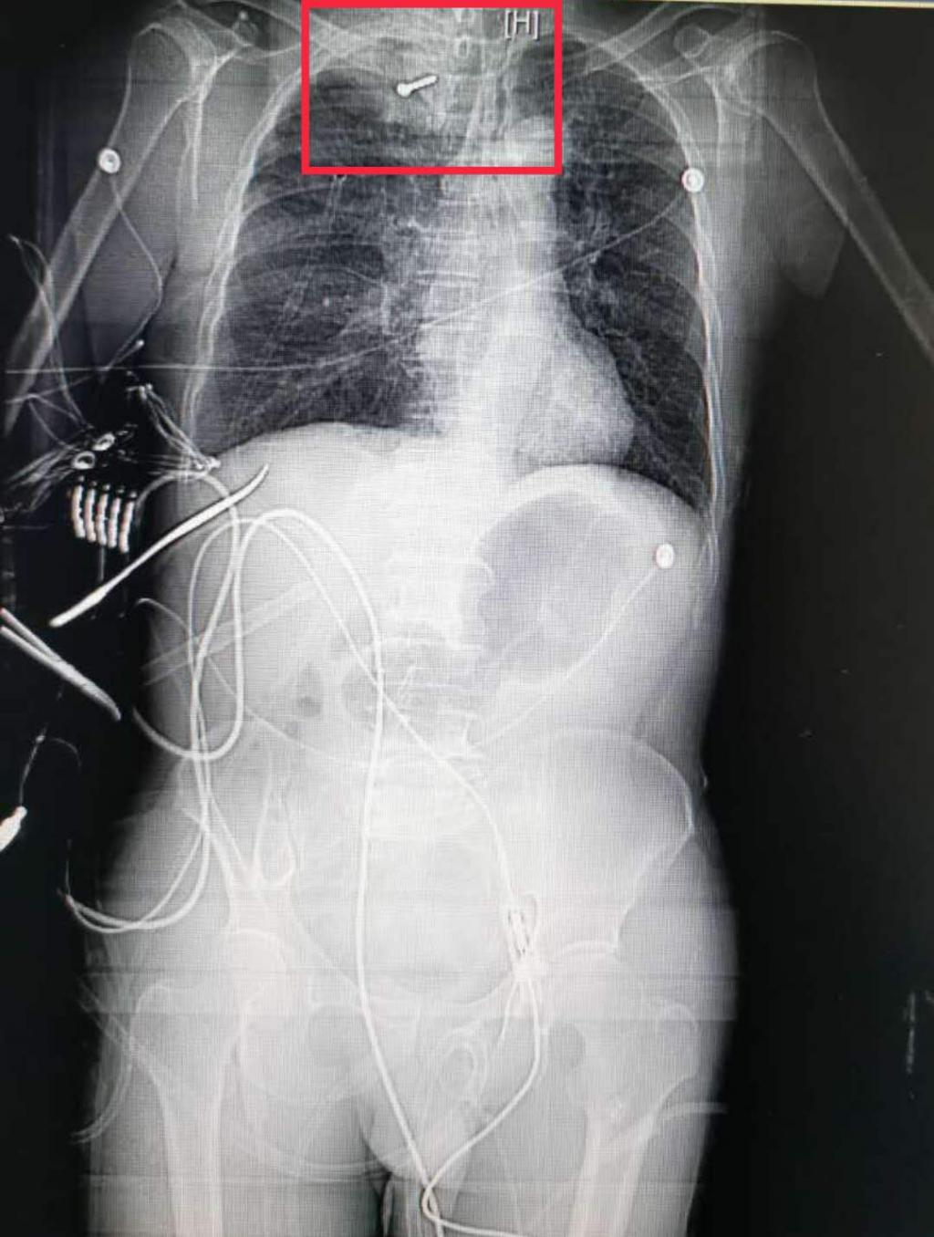钢钉工地气钉枪“走火” 3CM钢钉射入工人右肺险丧命！