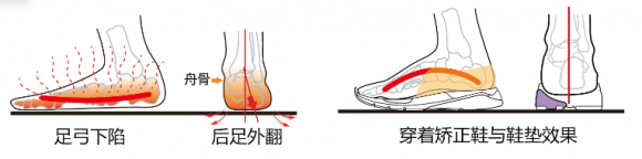 im体育严重扁平足孩子提早干预在黄金年龄给予矫正鞋矫正(图2)