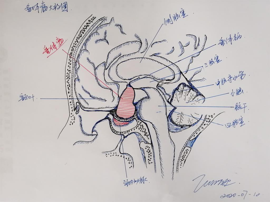 恶心呕吐20多天当"胃炎"治 原来脑袋里长了肿瘤