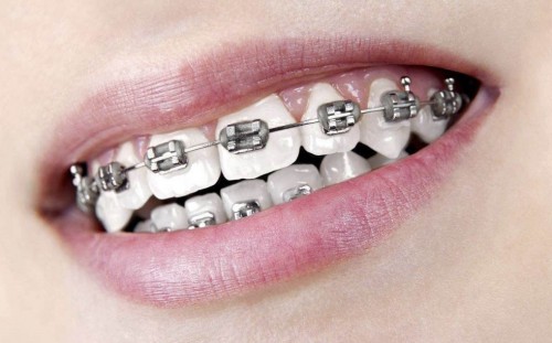 牙齿矫正如何预防牙套脸这几点你需要牢牢记住