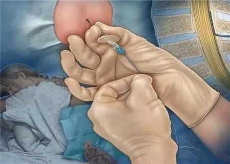 一组图看完剖腹产的全过程,每一个妈妈都是超人,男人都该看看