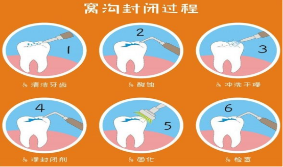 五為適齡兒童進行窩溝封閉