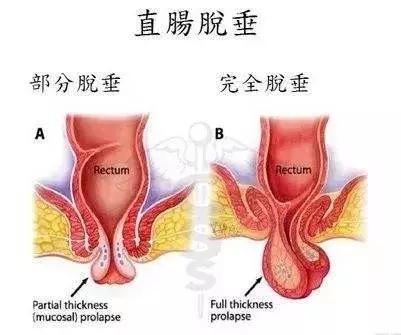 脱肛脱出的小尾巴是直肠还是痔疮