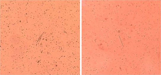 图1 紫色标记的为夏科--雷登结晶,绿色标记的为霉菌.