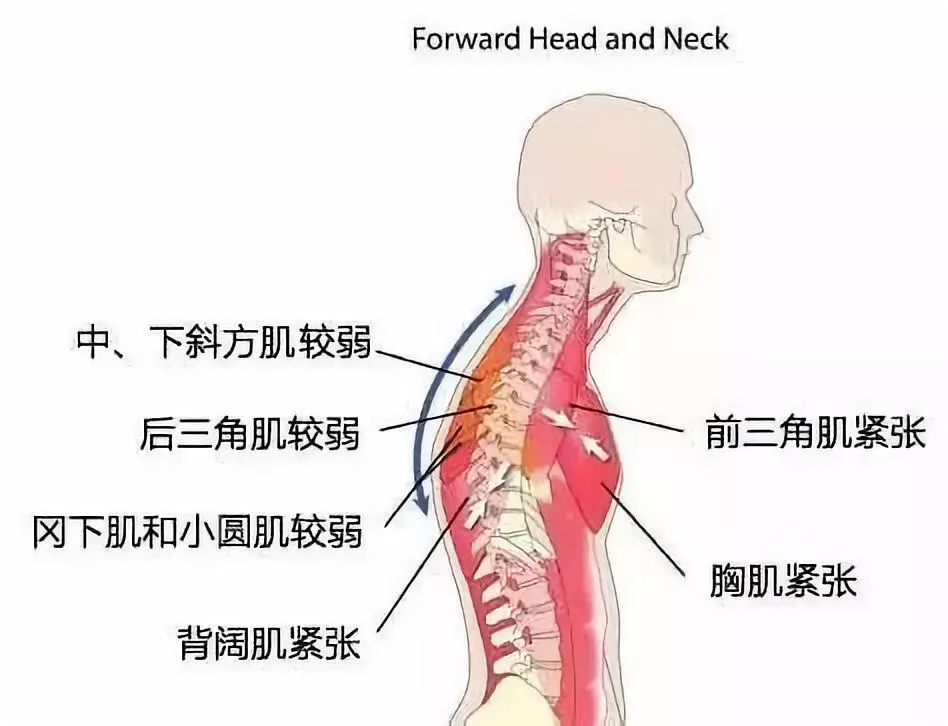 脖子前倾毁气质,更毁健康,该如何矫正?