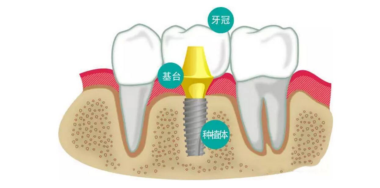 株洲哪家医院种植牙好,价格又便宜,技术又好